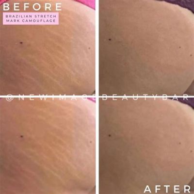 Cost of Camouflage Stretch Marks: The Hidden Price of Perfection